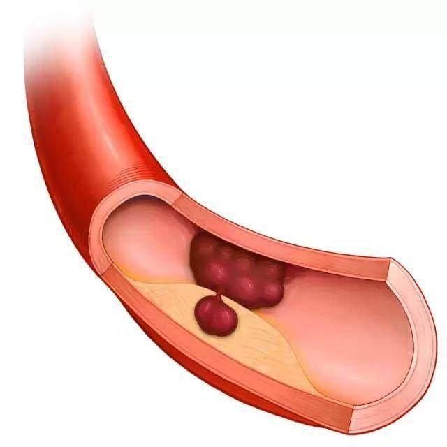 两个月内血栓易溶掉的奥秘与策略